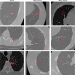 Exploring Fairness and Performance Drivers Across State-of-the-Art Pulmonary Nodule Detection Algorithms