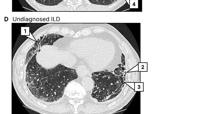 Expanded detection of early fibrotic phenotypes using lobar traction bronchiolectasis in lung cancer screening