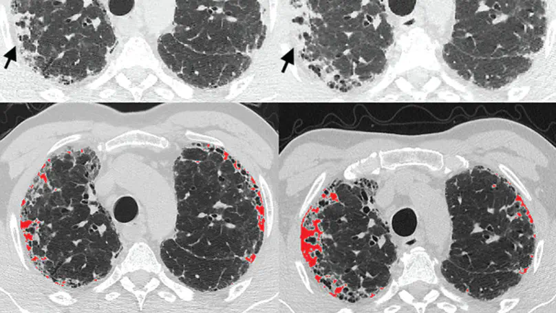 Delineating associations of progressive pleuroparenchymal fibroelastosis in patients with pulmonary fibrosis